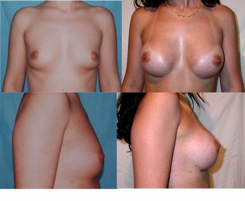 implanturi mamare