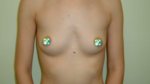 Cazuri clinice augmentare mamară (operații de mărire sâni) realizate de Prof. Dr. Anatolie Taran