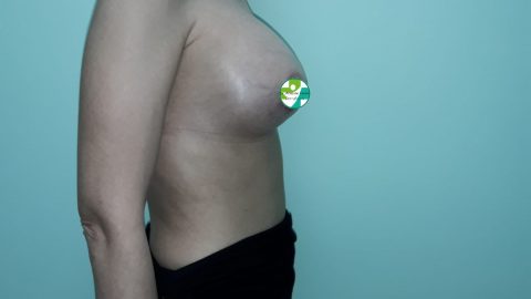 Cazuri clinice - Augmentare mamară (operație mărire sâni) realizate de chirurgul plastician Prof. Dr. Anatolie Taran:
