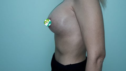 Cazuri clinice - Augmentare mamară (operație mărire sâni) realizate de chirurgul plastician Prof. Dr. Anatolie Taran: