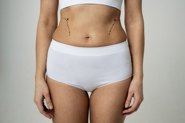 Liposuctie
