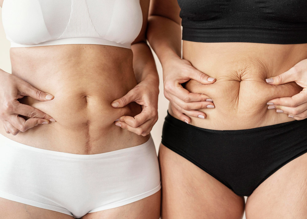 Abdominoplastie