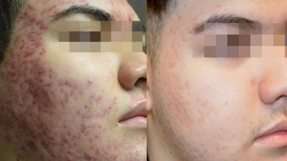Acne-1