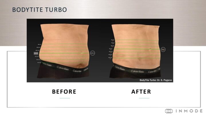 bodytite abdomen